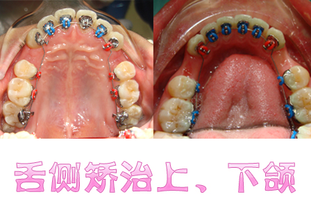 完全隐形的矫治-舌侧矫治